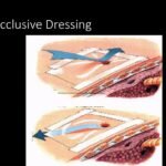 Flutter Valve (Occlusive Dressing)